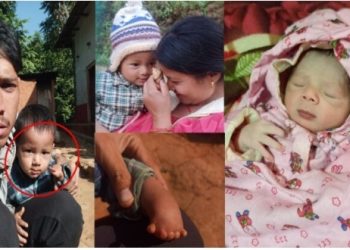 सञ्चारकर्मी बलबीर नेपालीको २ बर्षिय छोरा जेनिश नेपालीको हातको शल्यक्रिया गर्न आर्थिक अभाव